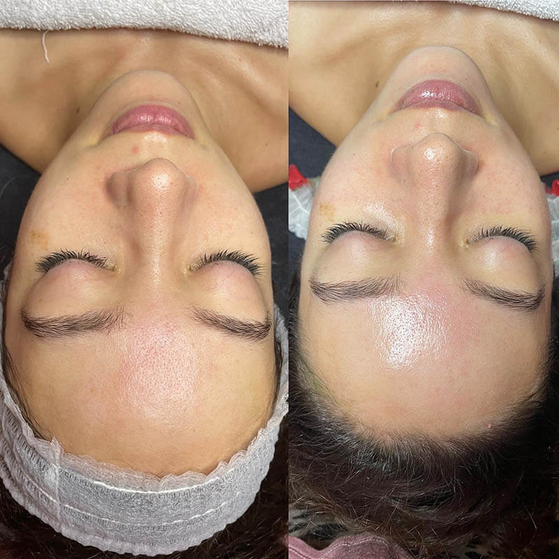 Microdermabrasion facial with jelly mask
